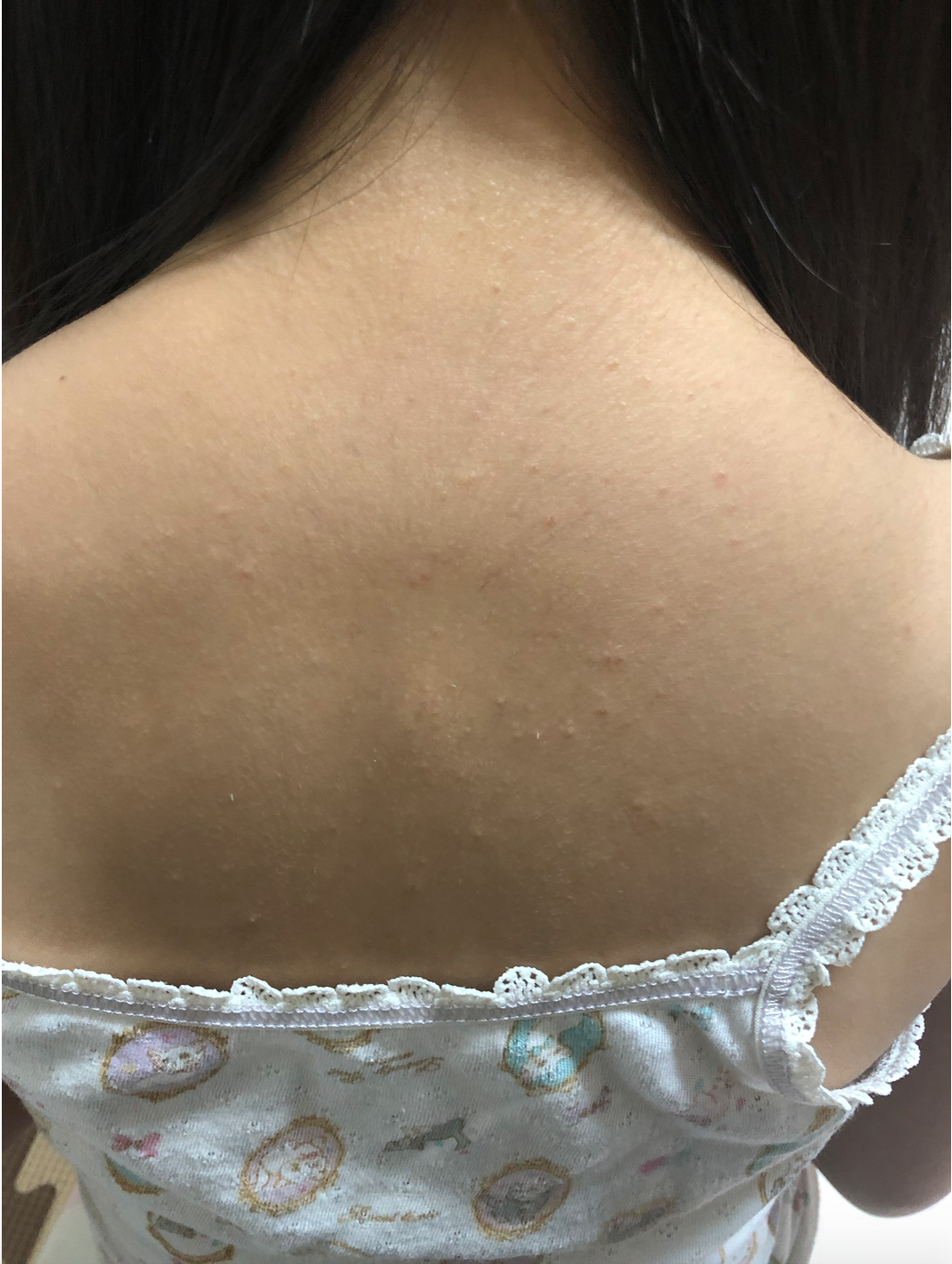背中にブツブツ発疹が 原因は 背中ニキビ Oda のブログ